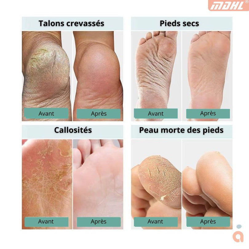 Rape à Pieds Electrique - Outil Pedicure - MDHL